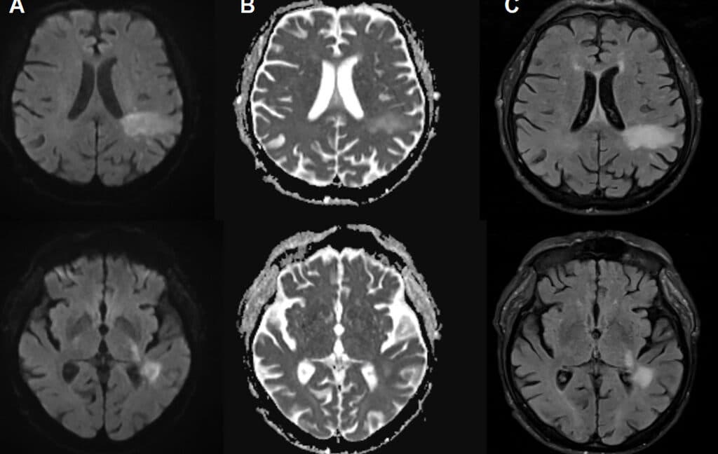 Illustration of human brain highlighting regions affected by PML.